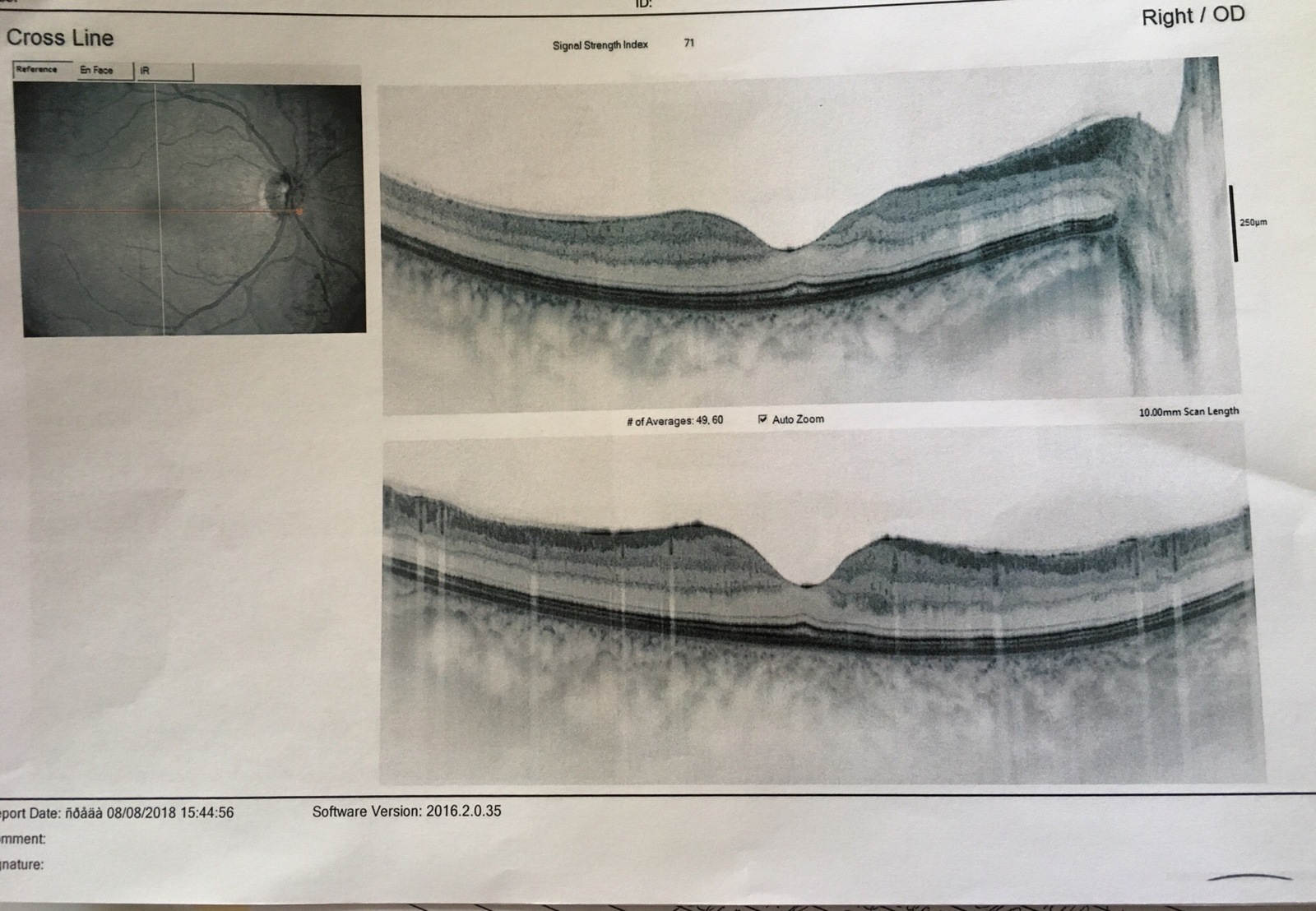 Ophthalmologists, surgeons (diabetologists) - need your opinion, please - My, Eyes, Surgery, Diabetes, Help, Operation, Longpost