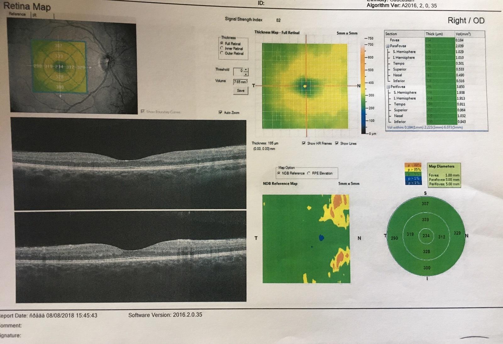 Ophthalmologists, surgeons (diabetologists) - need your opinion, please - My, Eyes, Surgery, Diabetes, Help, Operation, Longpost