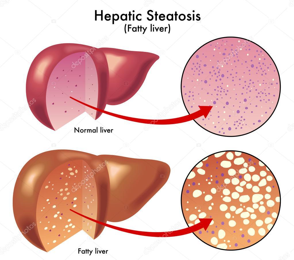 Cause of death #1 - My, Atherosclerosis, Plaque, Longpost, Video