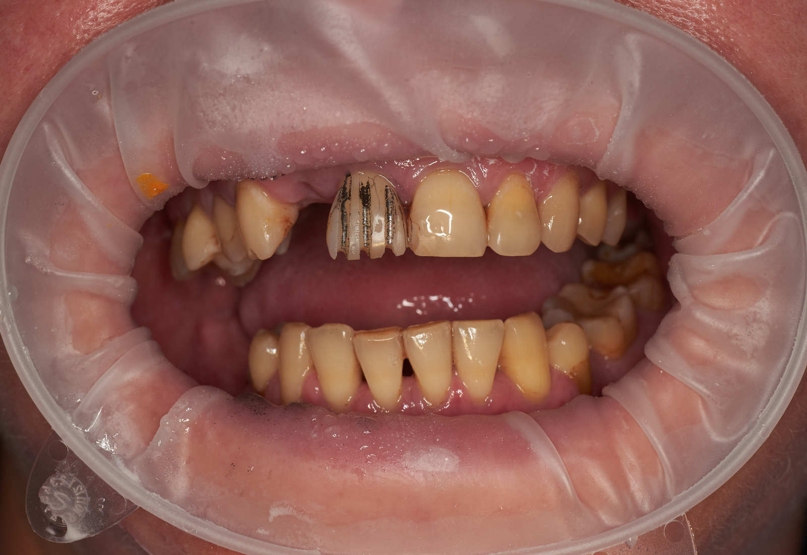 A little makeover - My, Teeth, cermet, Dentistry, Crowns, Work, Longpost