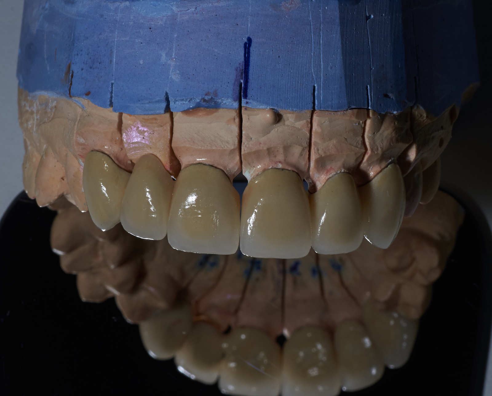 A little makeover - My, Teeth, cermet, Dentistry, Crowns, Work, Longpost