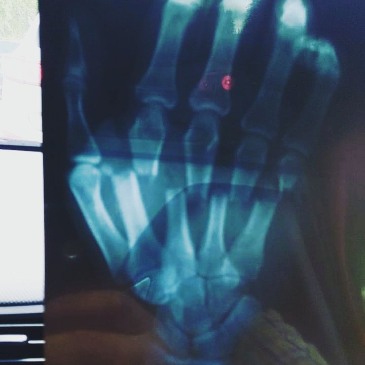 When you don't follow safety rules... - Safety engineering, X-ray, Loader, Hand, Brush, Injury