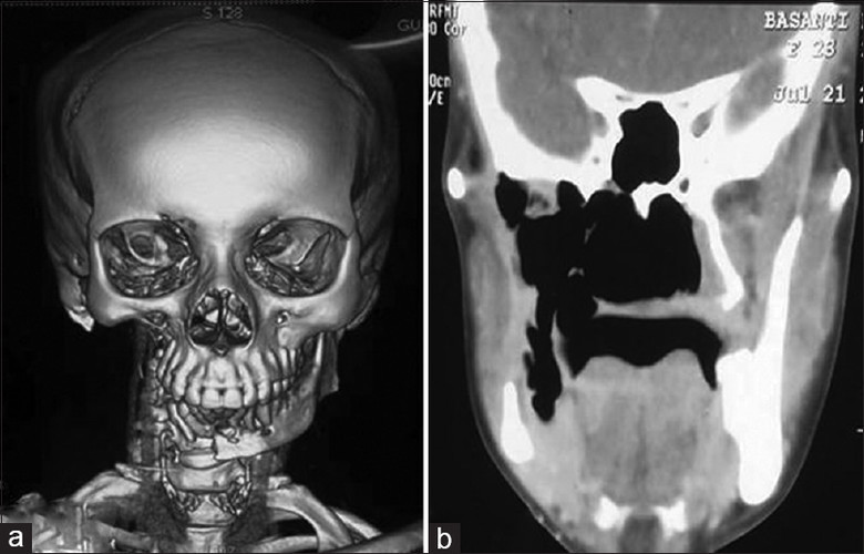 Vanishing bone syndrome - Disease, Bones, Longpost, The medicine