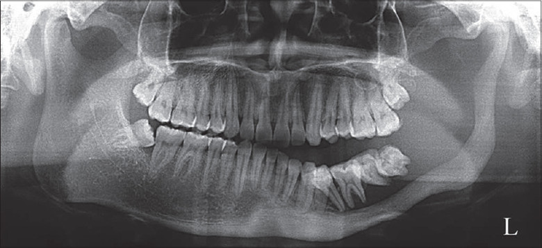 Vanishing bone syndrome - Disease, Bones, Longpost, The medicine