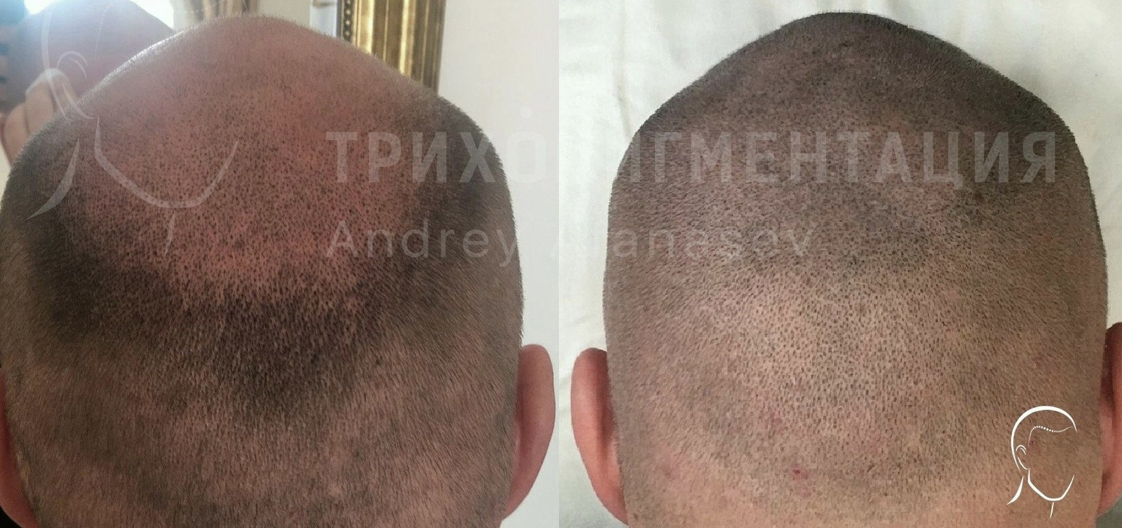 Tricopigmentation of hair. A relatively new way to hide baldness as a global trend. - My, Trichopigmentation, Baldness, Hair Transplant, Appearance