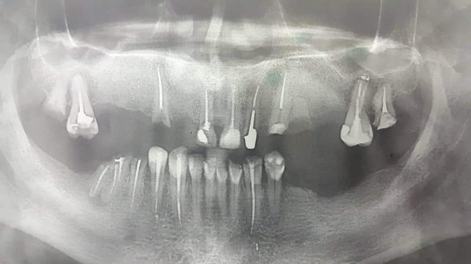 To all my subscribers - what I chose and what happened in the end - My, Dentistry, Implantation, No rating, Teeth, Longpost