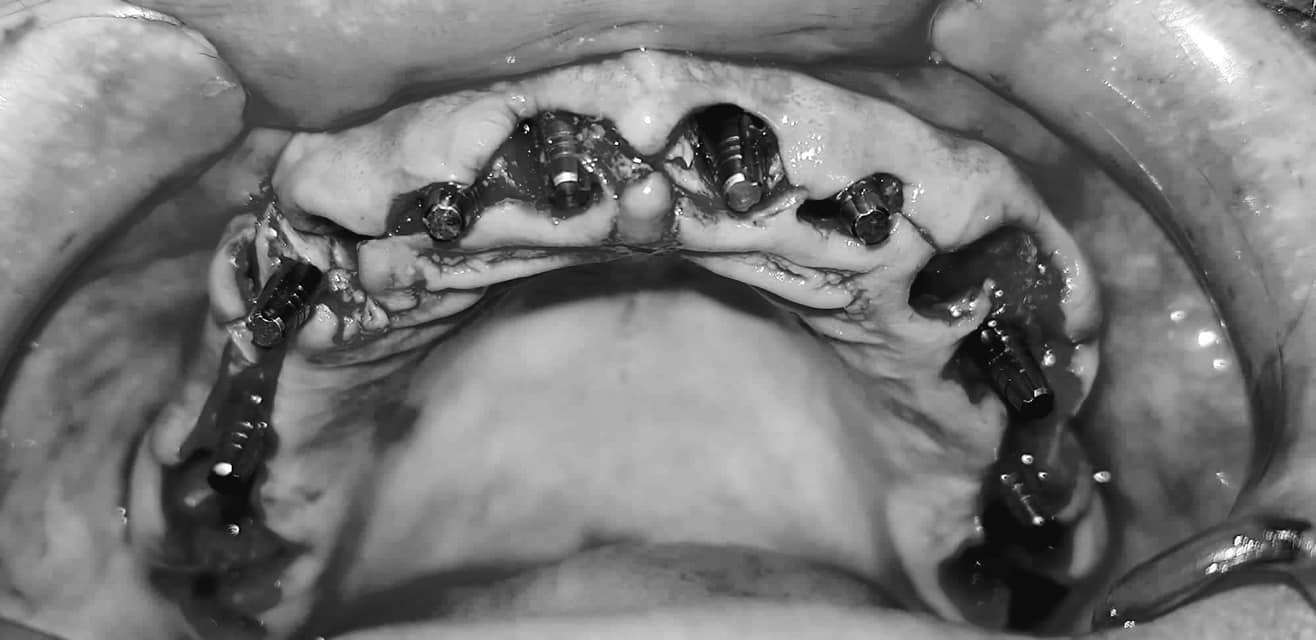 To all my subscribers - what I chose and what happened in the end - My, Dentistry, Implantation, No rating, Teeth, Longpost