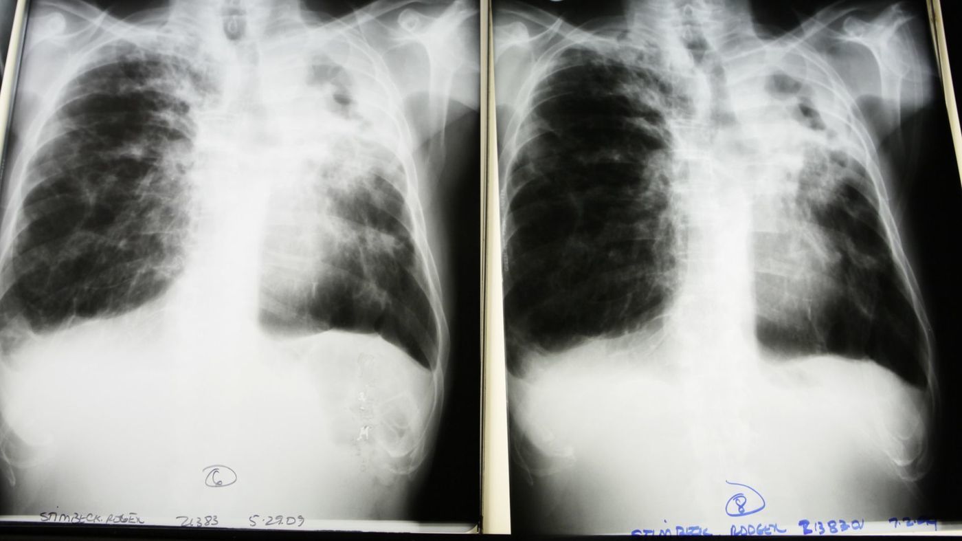 Как выглядит туберкулез на снимке