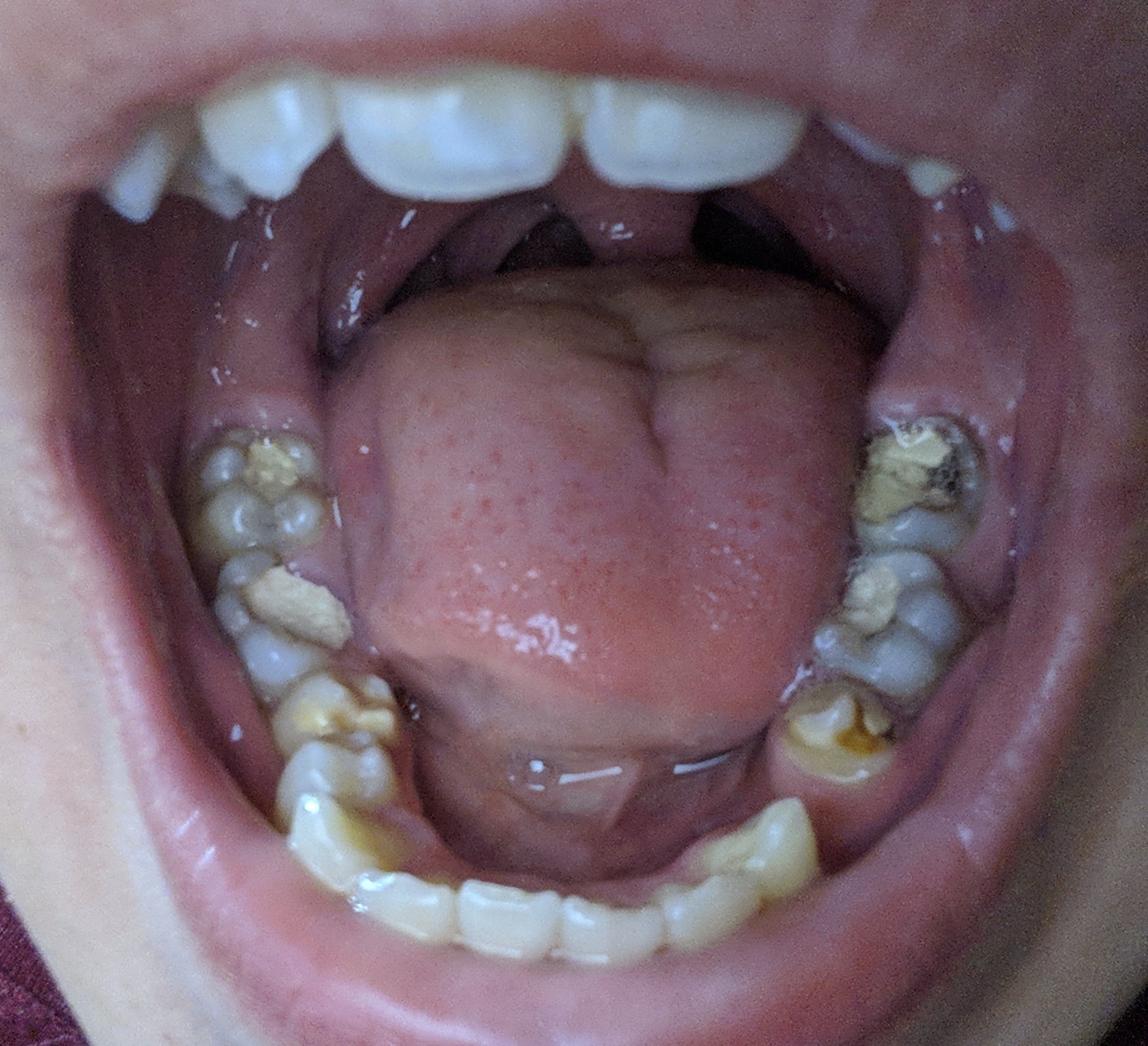 My terrible teeth 2( - Teeth, Seal, Caries, Teenagers