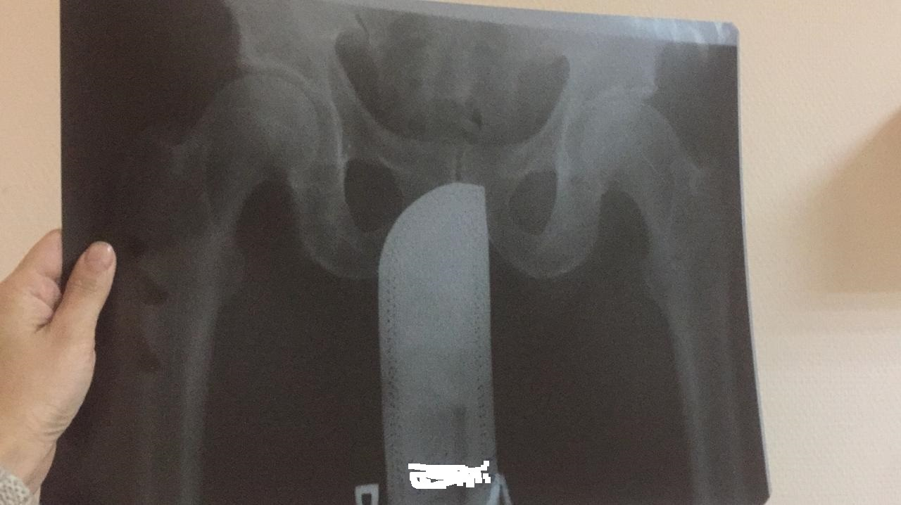 What's this? - X-ray, Foreign body