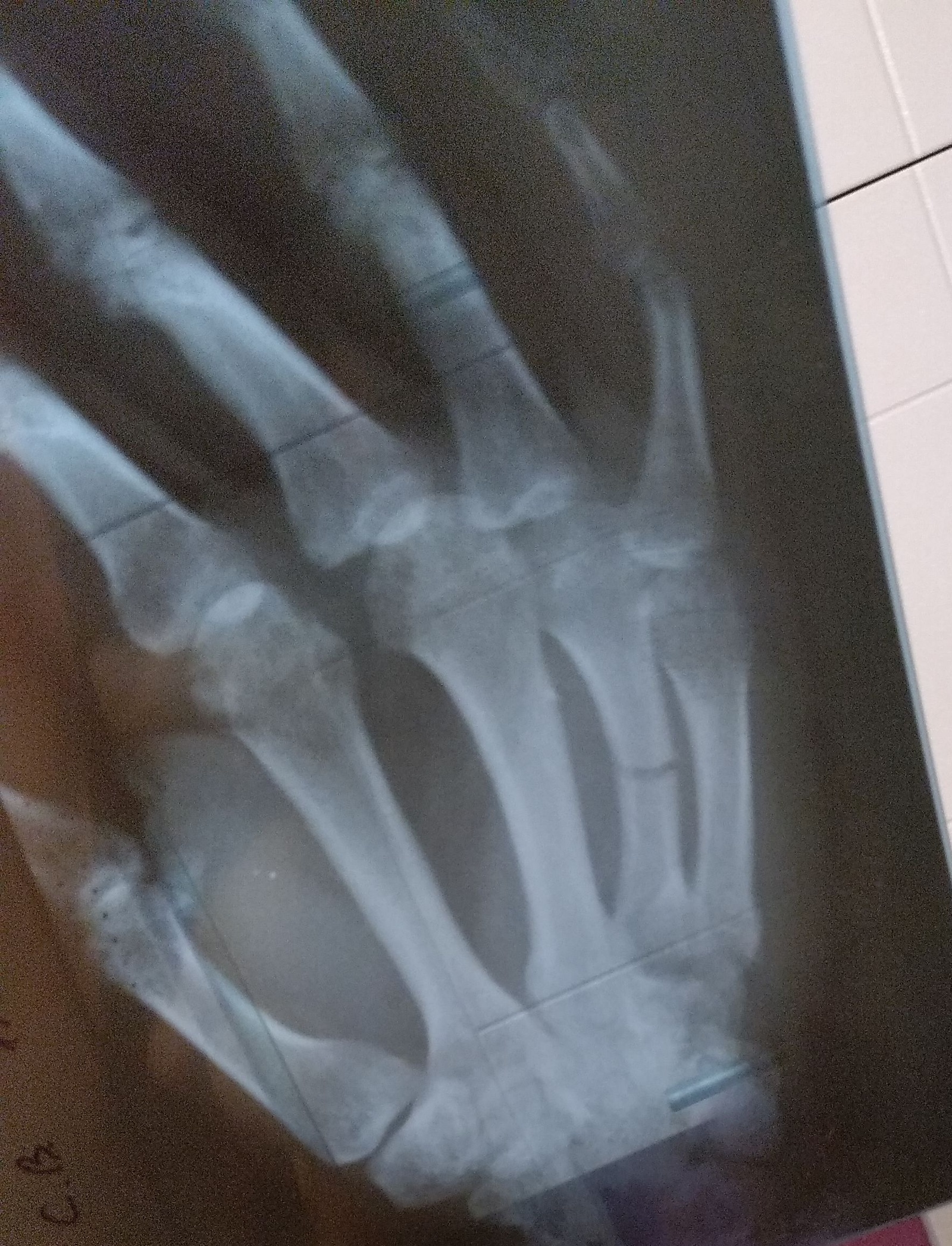 Re-injury - , Fracture