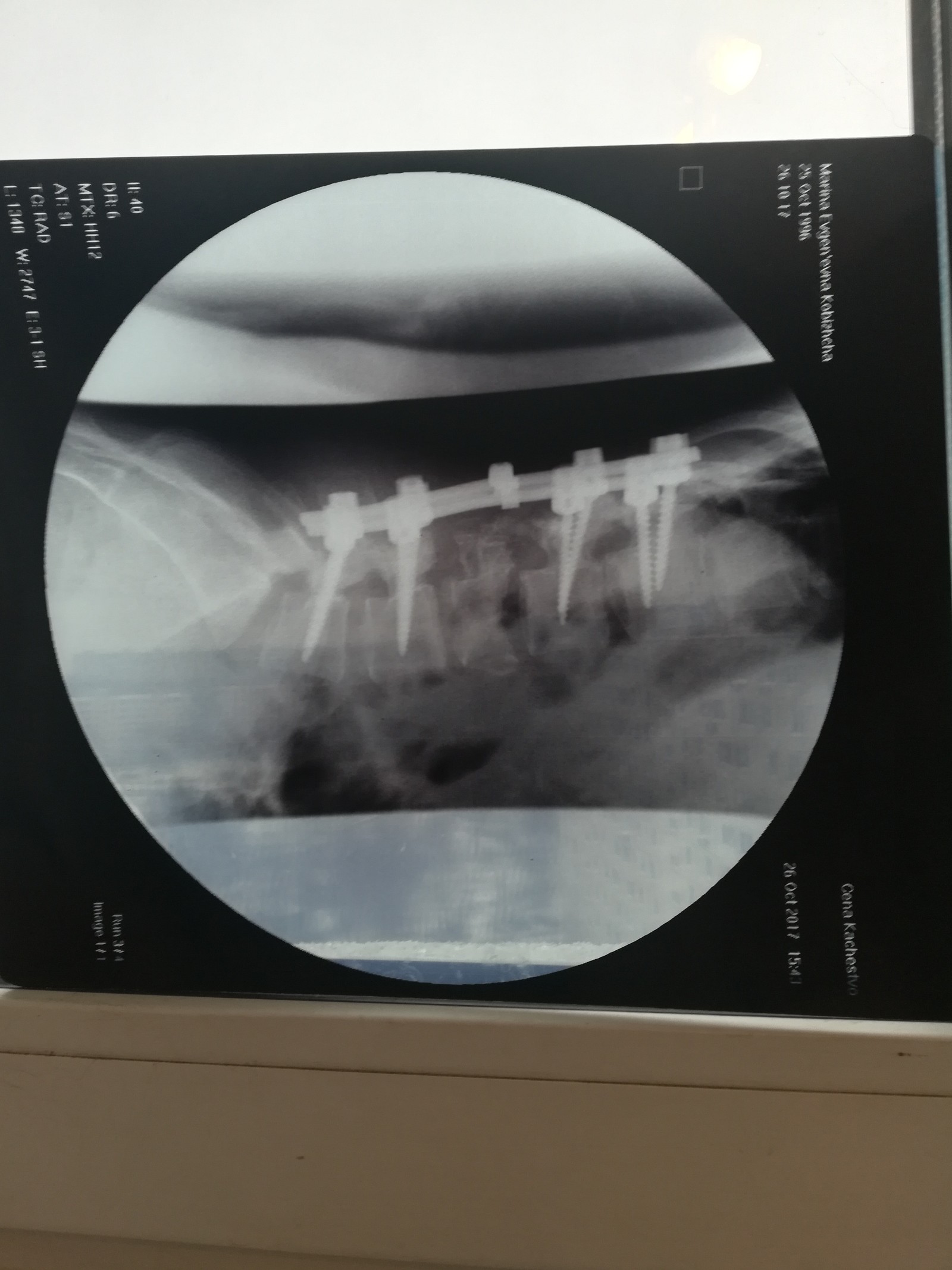 Cheerful family! - My, , Spine, Fracture, X-ray