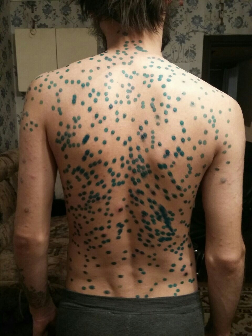 Chickenpox - My, Chickenpox, Disease