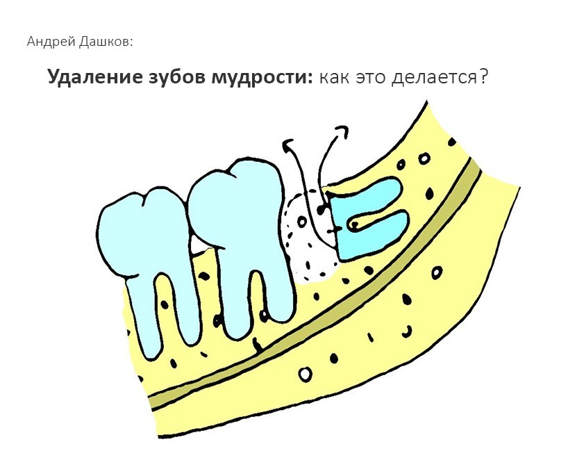 Removal of wisdom teeth. How it's done? - My, Dentistry, Wisdom tooth, Teeth, , Surgery, Doctors, Surgeon, The medicine, Longpost