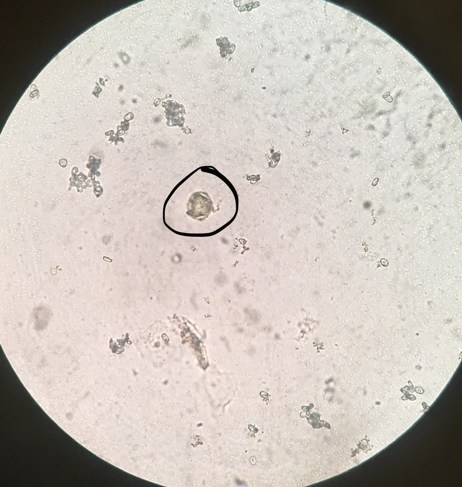 Микроскопическое исследование предстательной железы. Спермограмма лецитиновые зерна микроскопия. Секрет простаты микроскопия атлас. Амилоидные тельца в секрете простаты микроскопия. Микроскопия секрета простаты.