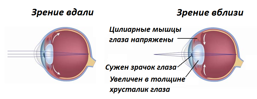 Laser vision correction. - My, Laser correction, Longpost, Vision