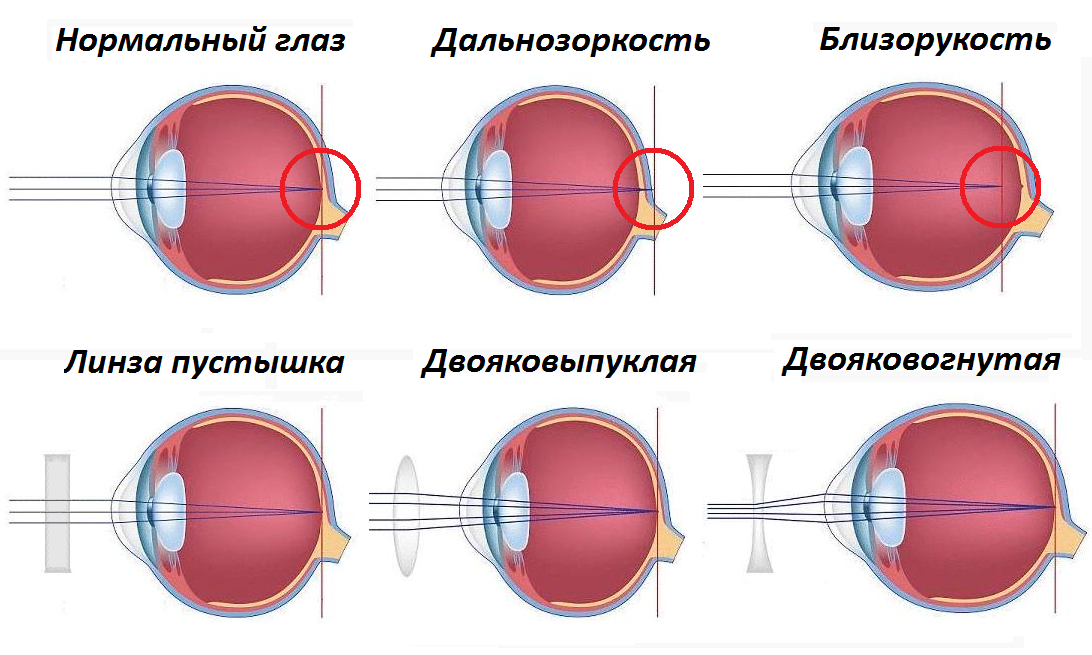 Коррекция зрения с помощью линз. Дальнозоркость и близорукость строение глаза. Строение глаза при миопии. Близорукость строение глаза. Строение глаза при близорукости и дальнозоркости.