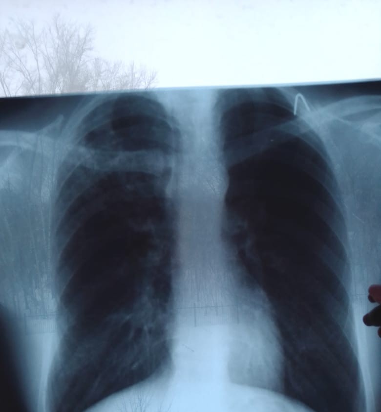 How do I get tuberculosis (part 2) (in the hospital) - My, Tuberculosis, Disease, Longpost