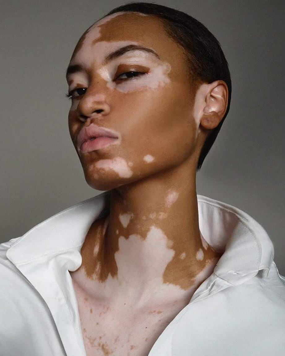 Vitiligo - Skin disease, , Longpost, Dermatology