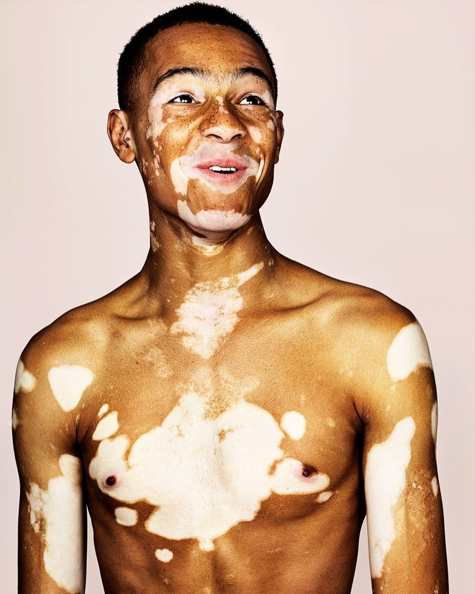 Vitiligo - Skin disease, , Longpost, Dermatology