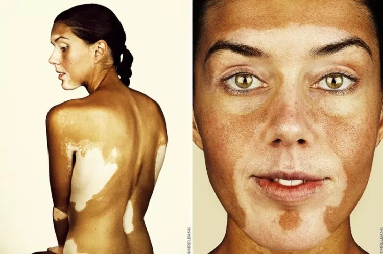 Vitiligo - Skin disease, , Longpost, Dermatology