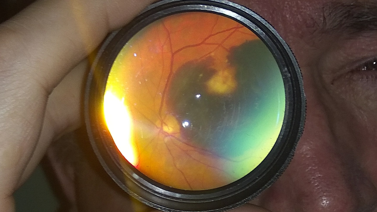 Ocular fundus - My, Eyes, Ocular fundus