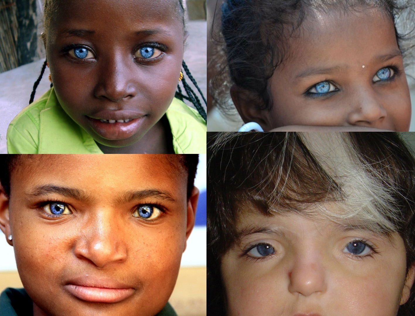 Синдром Ваарденбурга красивые глаза