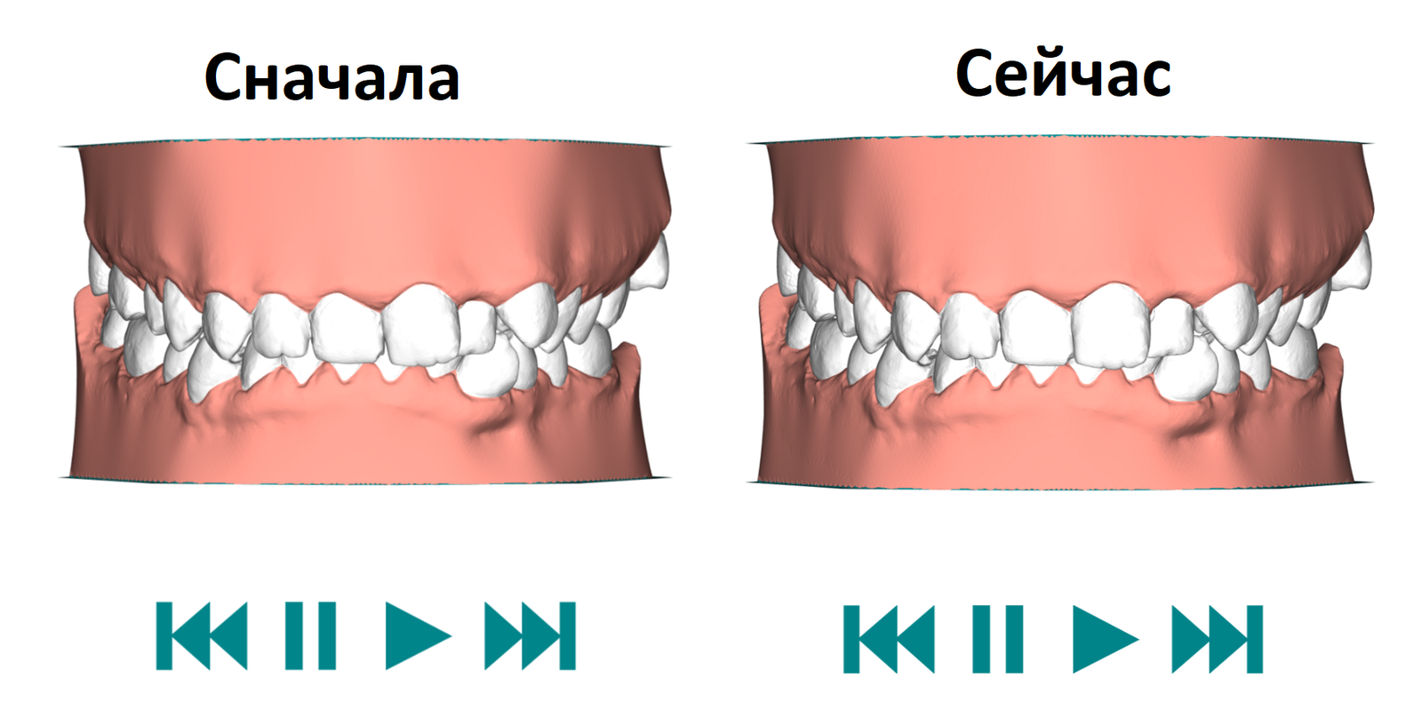 Aligners. Sixth couple. 1-12 days of wear - Malocclusion, Personal experience, My, Aligners, Bite correction