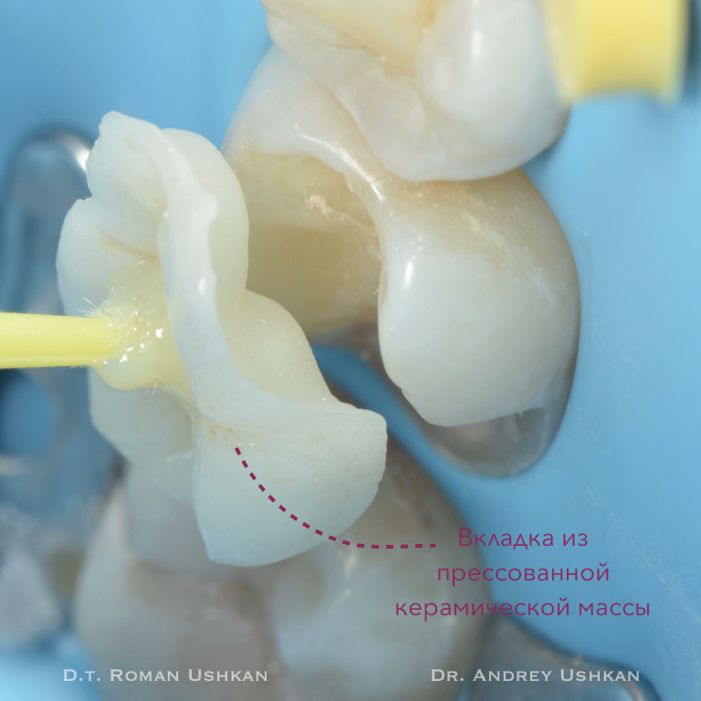 Indirect tooth restoration - My, Dentistry, Teeth, Smile, Longpost