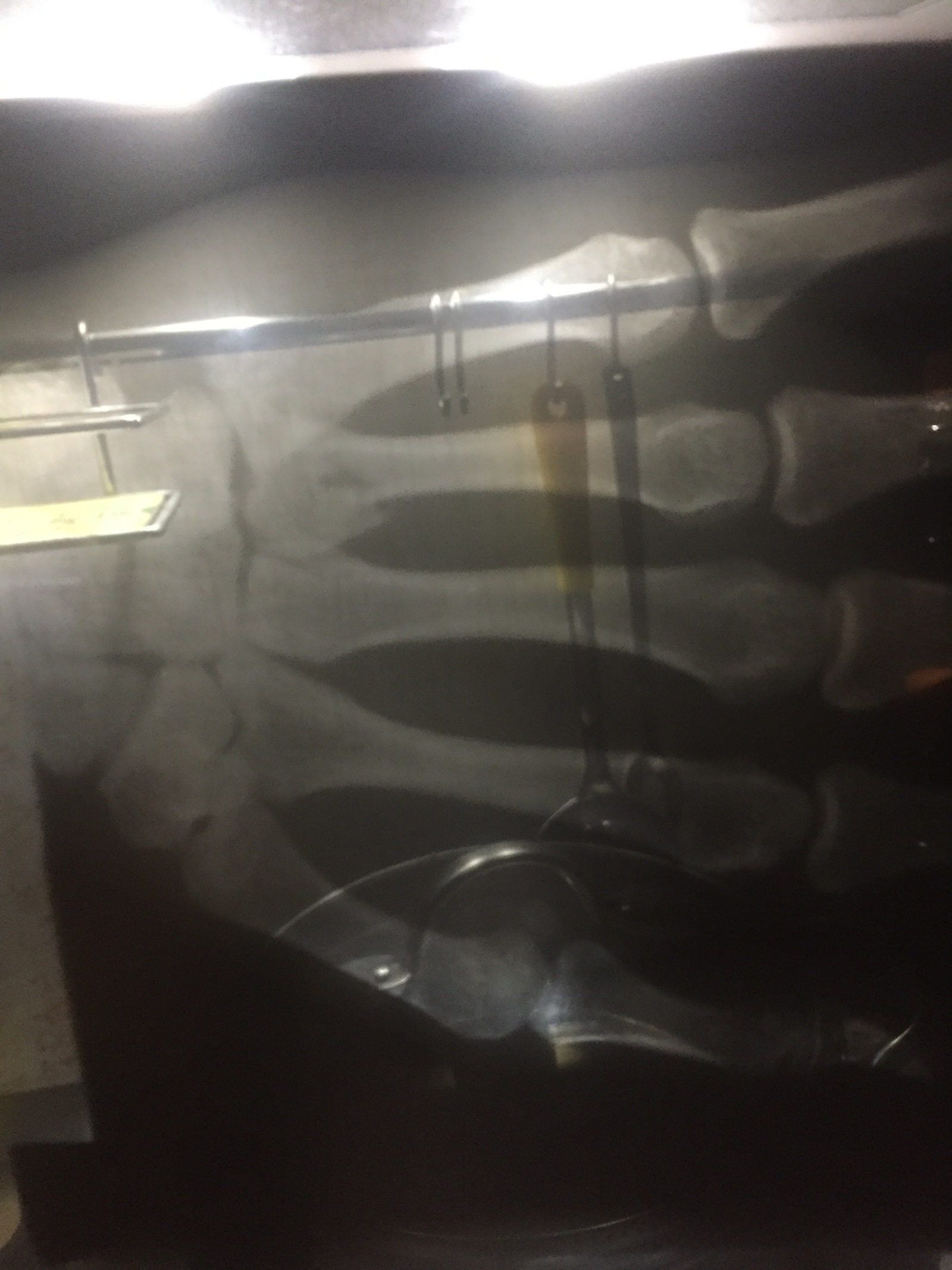 Broken. Need help. - My, Fracture, Doctors, Life stories, To tears, Longpost