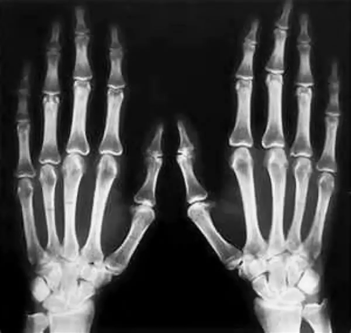 Arachnodactyly (literally spider fingers) - Pathology, Anatomy, Longpost