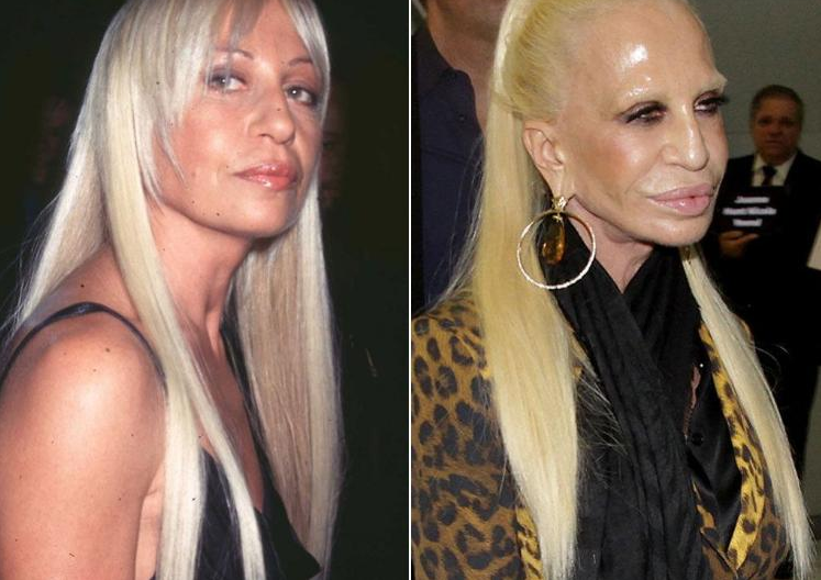 Stars before and after plastic surgery! - Celebrities, It Was-It Was, Longpost