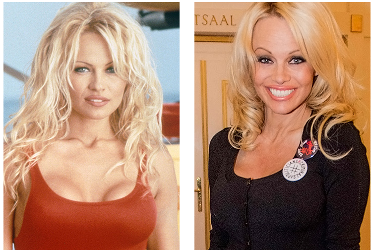 Stars before and after plastic surgery! - Celebrities, It Was-It Was, Longpost