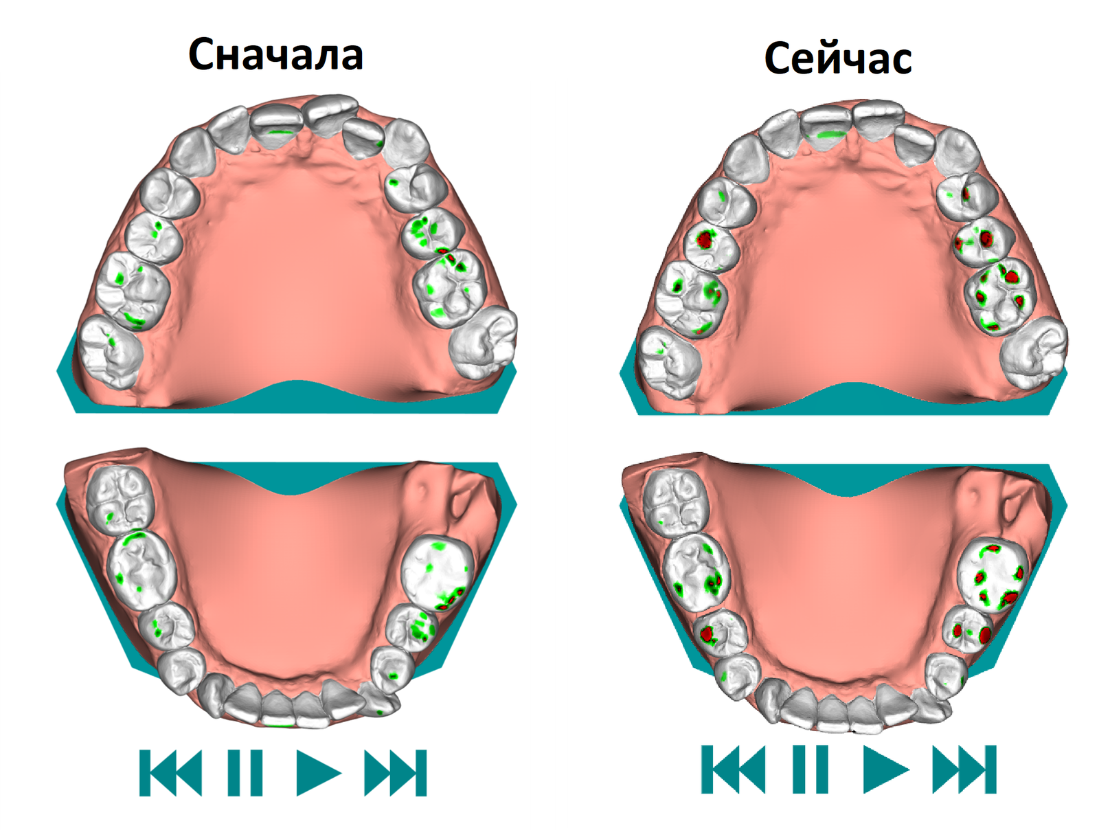 Aligners. 12 pair. - My, Aligners, Bite correction, Malocclusion, Personal experience, Longpost