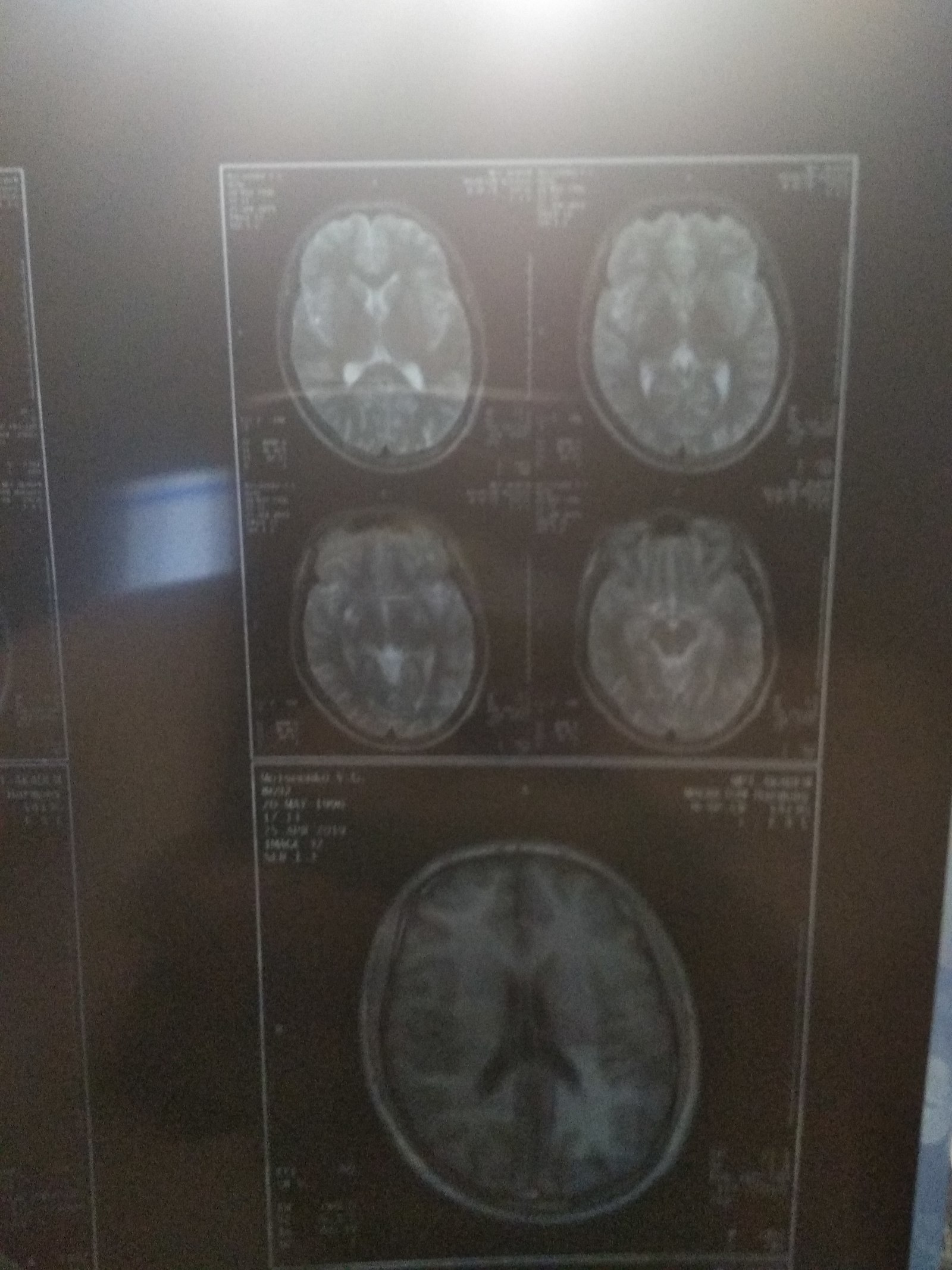 MRI of the brain. Cyst - My, Cyst, MRI, Doctors, Neurosurgery, The medicine, Longpost