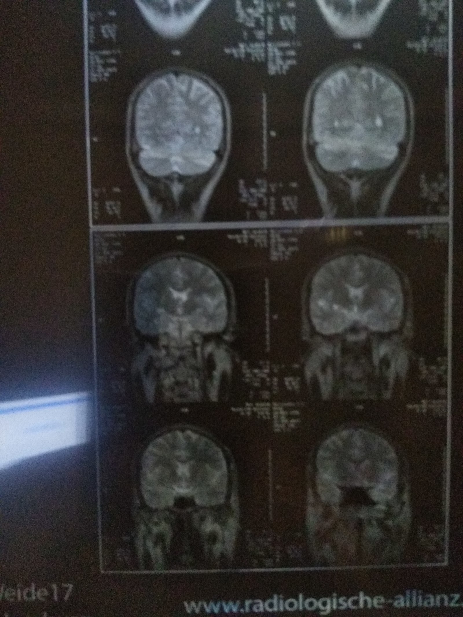 МРТ Головного мозга . Киста | Пикабу