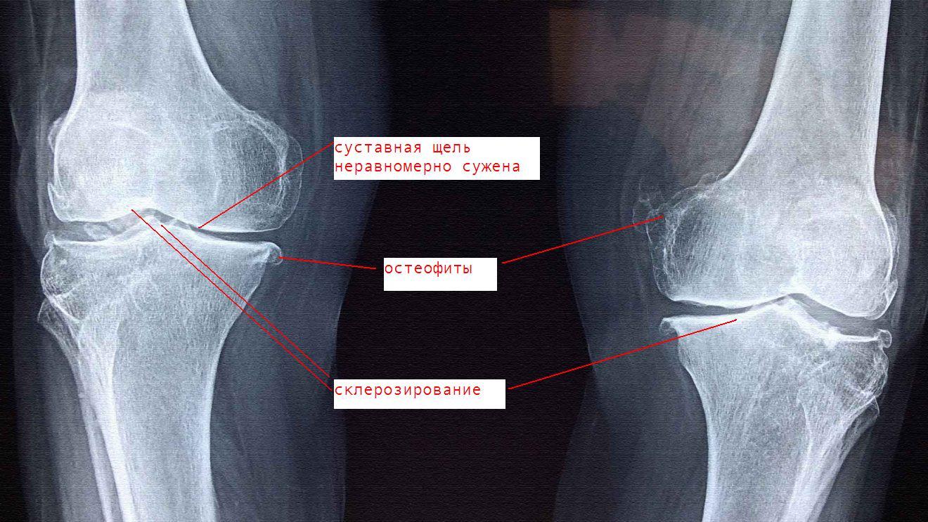 Два мыщелка. Суставная щель коленного сустава рентген. Остеоартроз рентген остеофиты. Остеофиты коленного сустава рентген. Краевые остеофиты коленного сустава рентген.