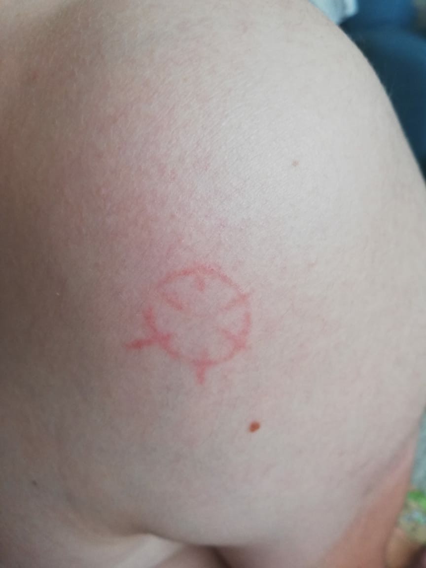 Strange mark on the body - My, Body, Signs
