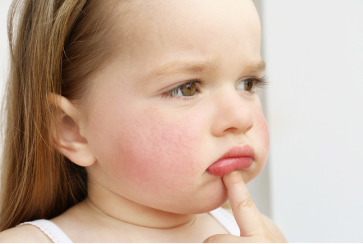 Себорейный дерматит на лице фото у детей