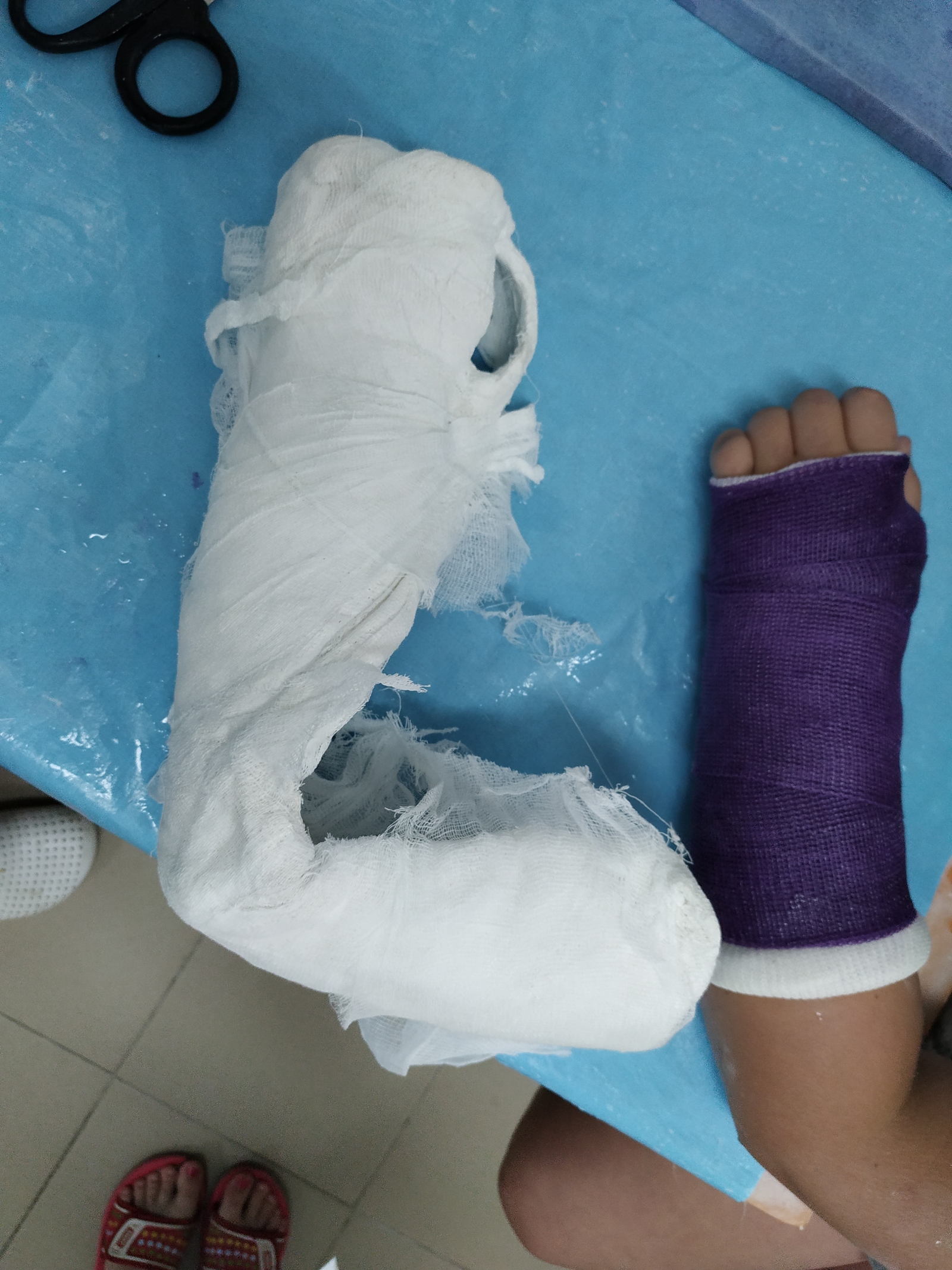 A little about plastic bandage - My, Fracture, Doctors, Traumatology, Longpost