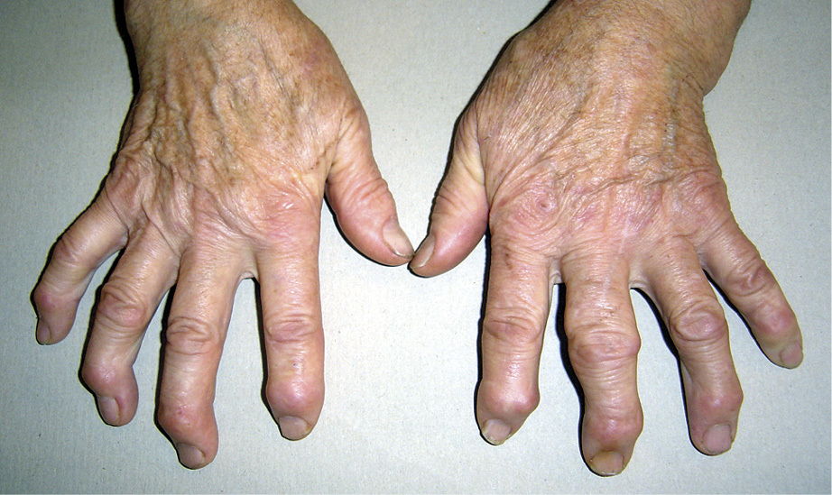 Artritis reumatoide seronegativa