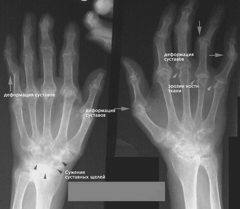 Ревматоидный артрит - Медицина, Длиннопост, Ортопедия, Ревматоидный артрит
