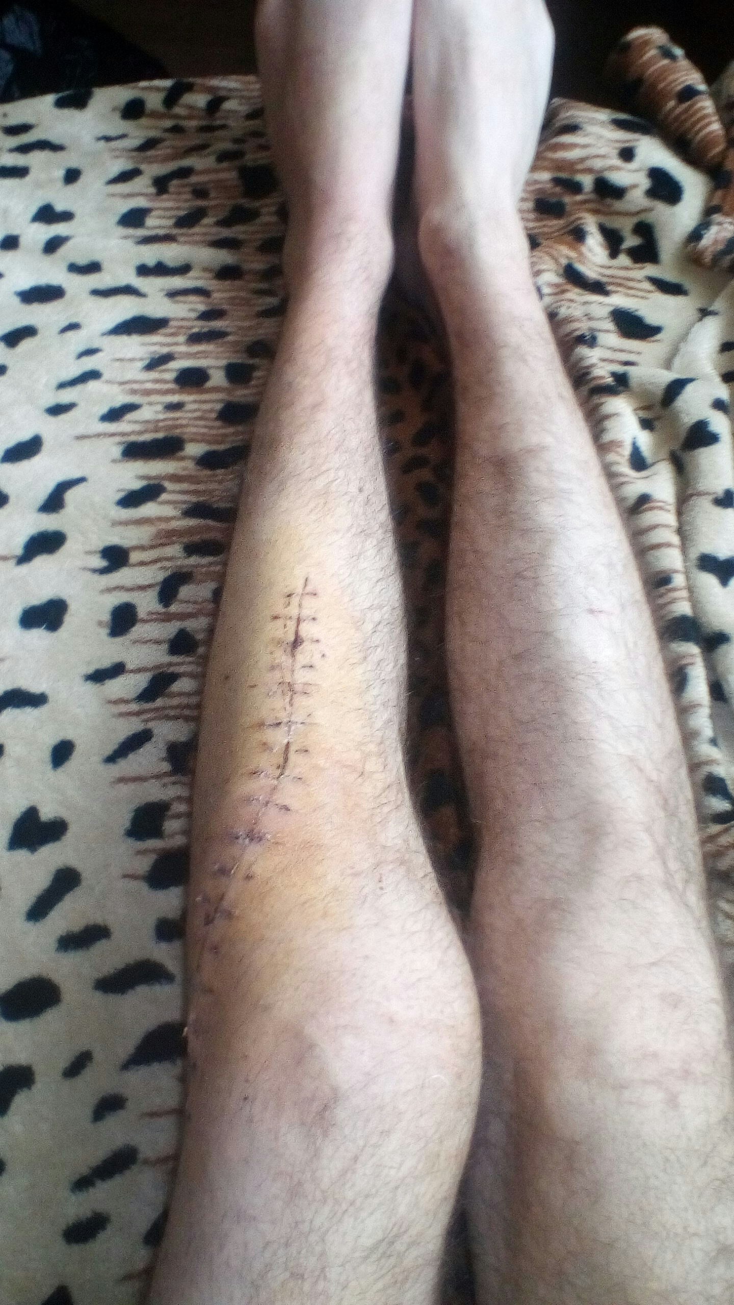 I ask for the help of those who are not indifferent - My, Broken leg, A desperate situation, Type 1 diabetes mellitus, cat, Products, Without work, Saint Petersburg, Longpost