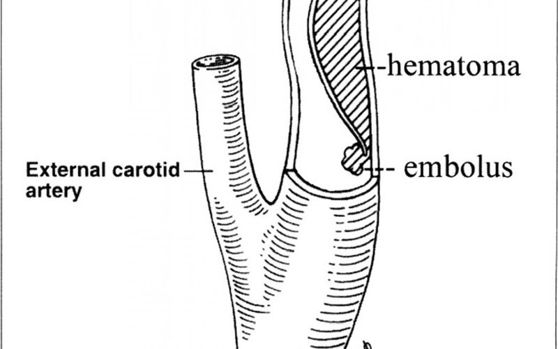 Dissection of the carotid artery, and at the same time the removal of the tonsils with a coblator. - My, Tonsils, Stroke, Chronic tonsillitis, VMP, Medical records, Longpost