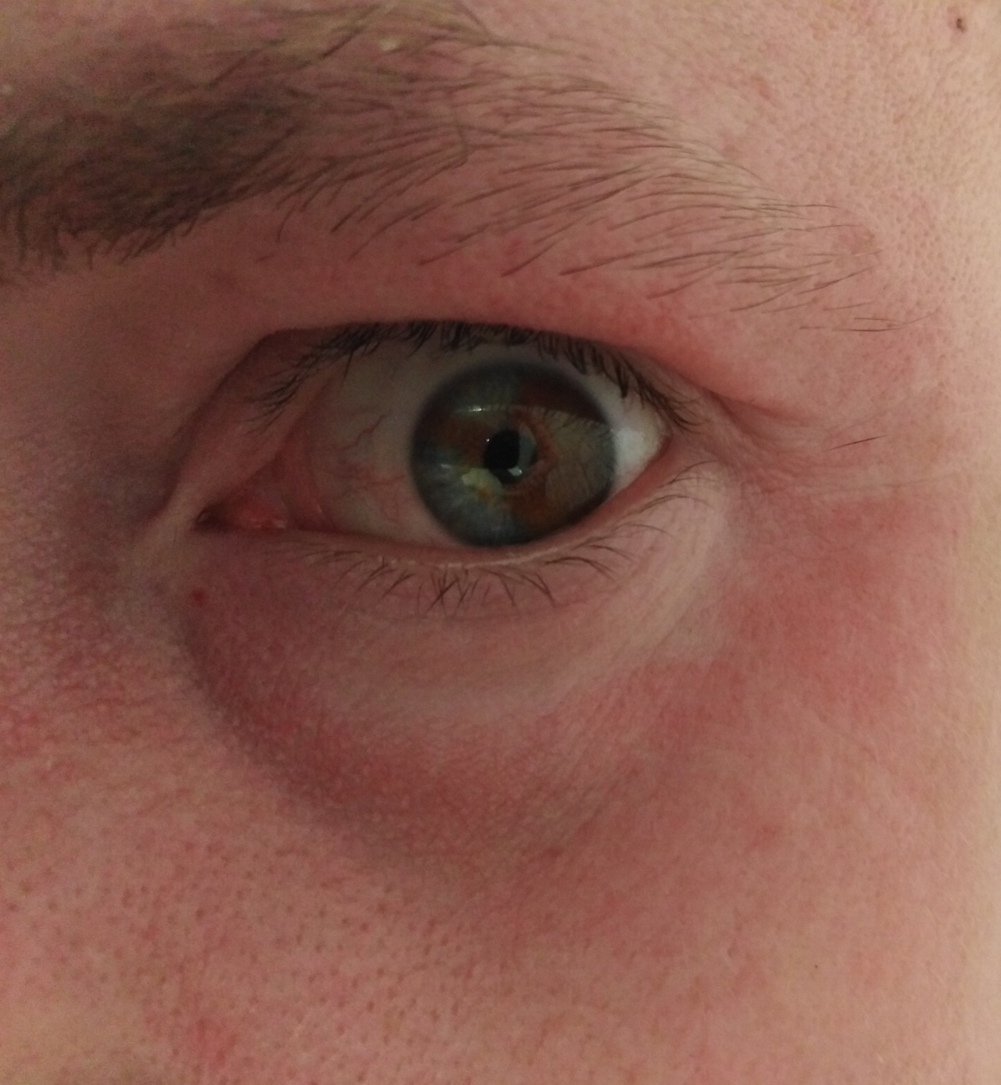 A case in a barbershop, or about genetic mutations. - My, Vitiligo, Heterochromia, Barbershop