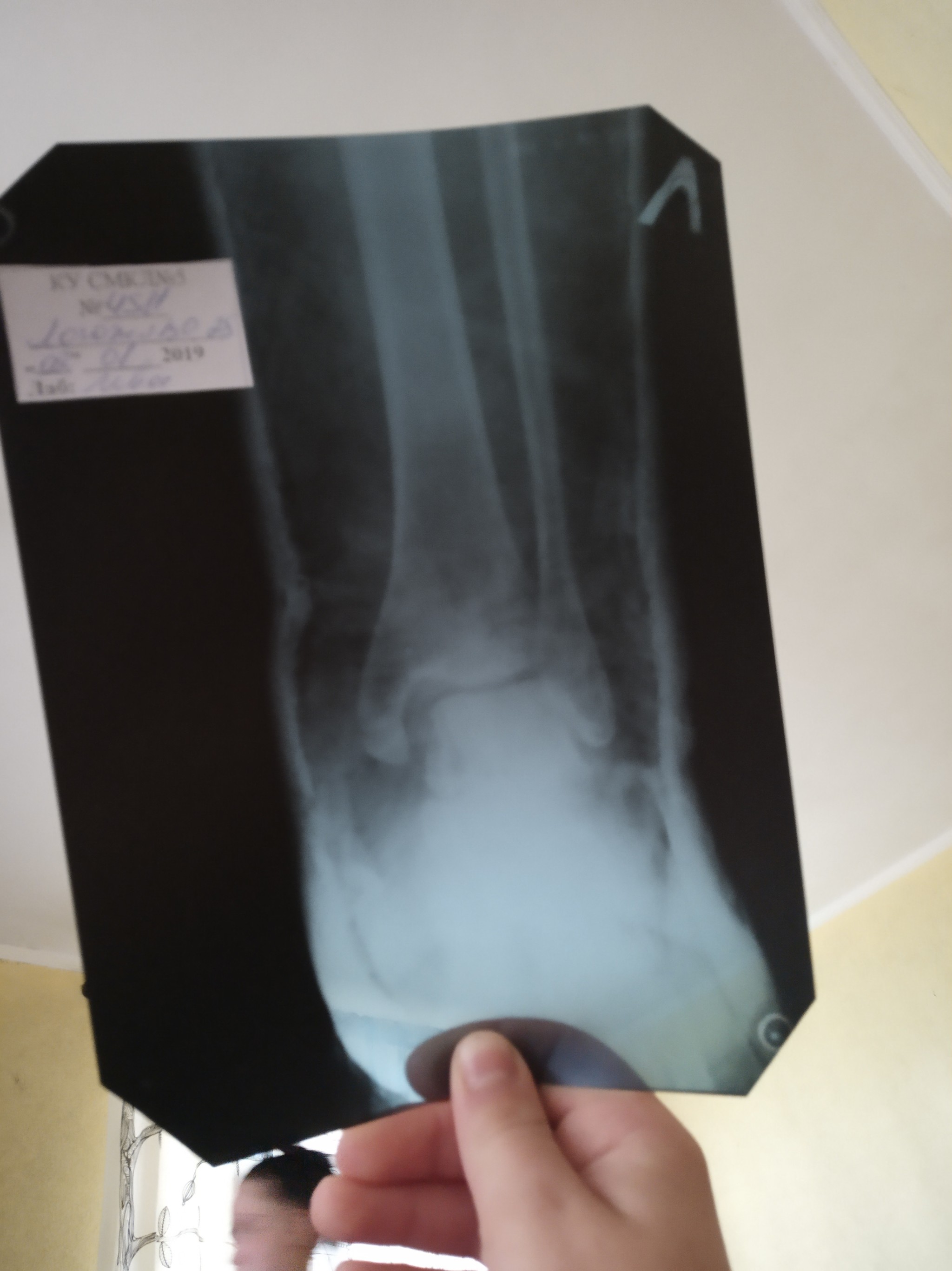 Help decipher (ukr. language) handwriting - My, Fracture, Doctor's handwriting, No rating