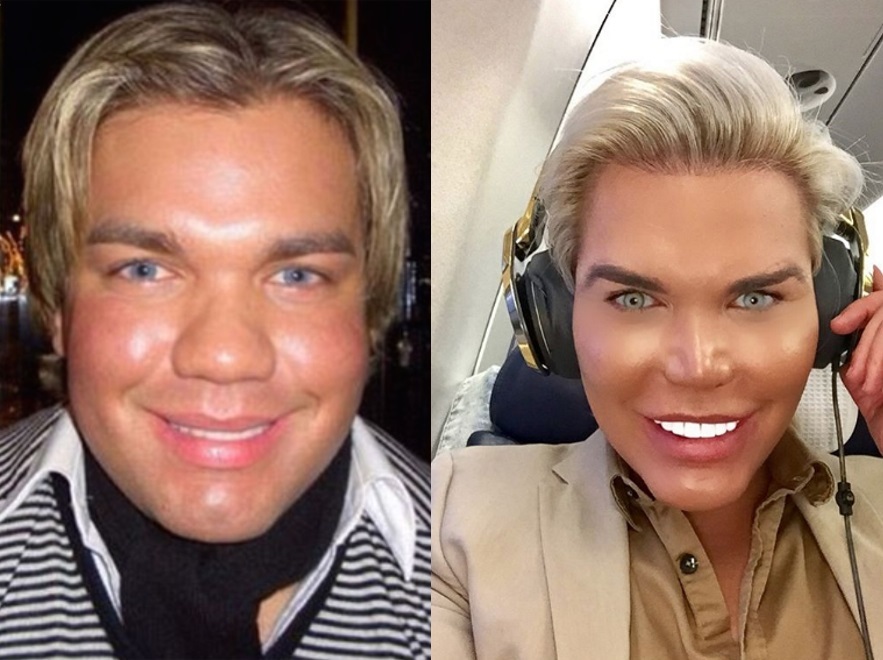 How to turn into a living Ken? Operation history of Rodrigo Alves. - My, Cosmetology, Plastic surgery, Face, The medicine, Fashion, beauty, Psychology, Longpost