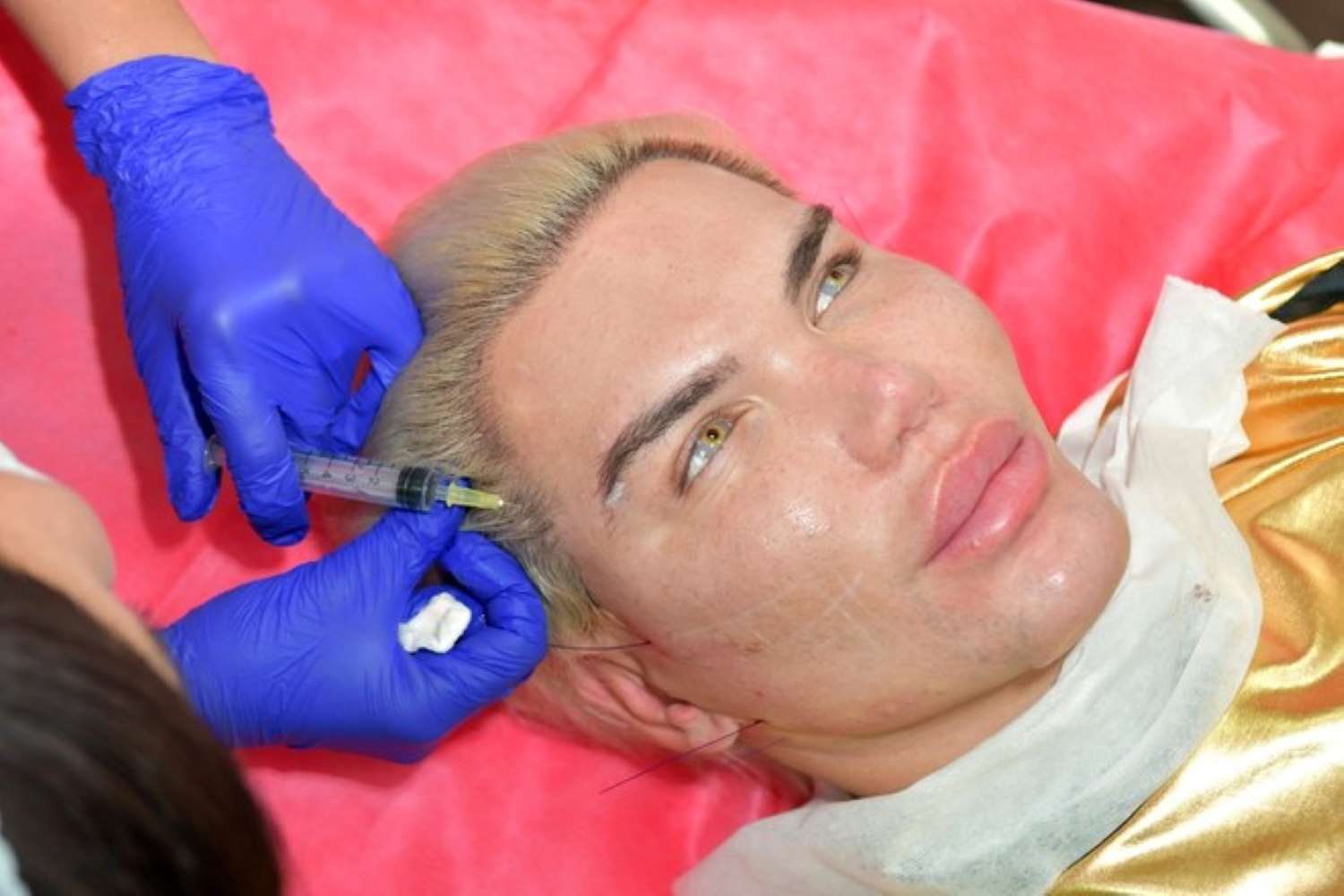 How to turn into a living Ken? Operation history of Rodrigo Alves. - My, Cosmetology, Plastic surgery, Face, The medicine, Fashion, beauty, Psychology, Longpost