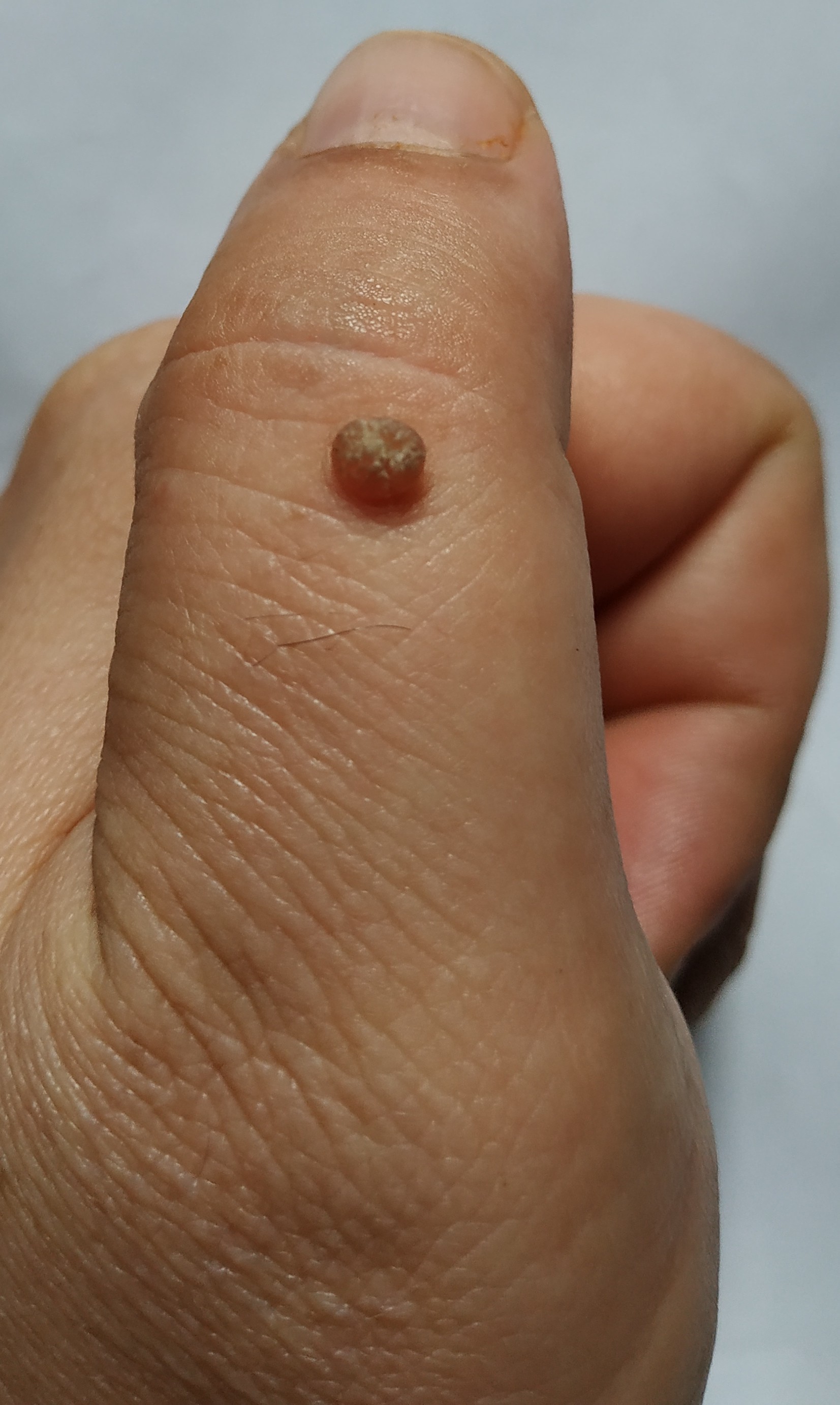 Wart removal. - My, The medicine, Operation, Longpost