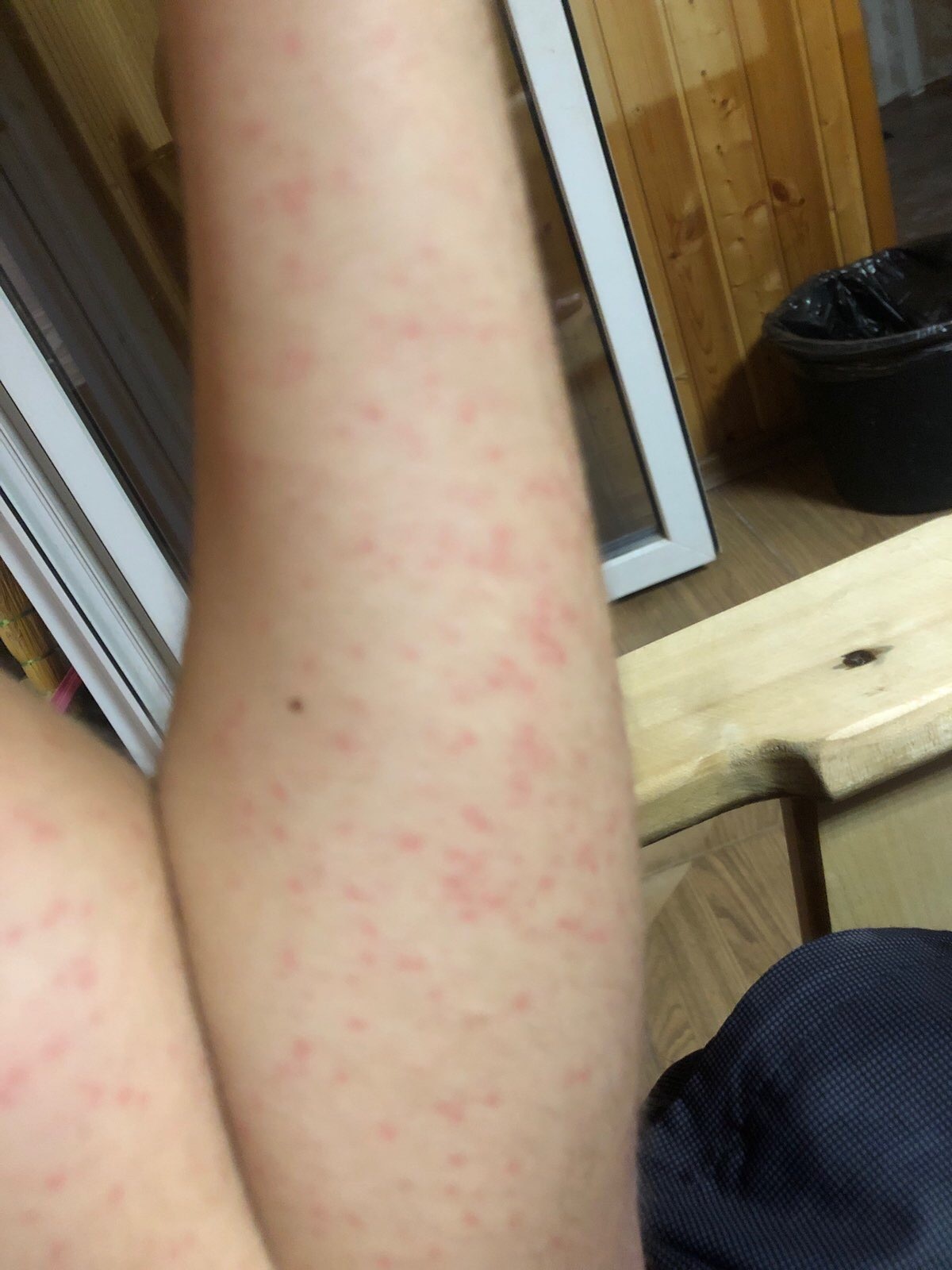 hives - My, Cholinergic urticaria, Hives, Longpost